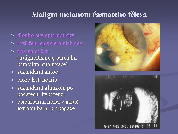 Maligní melanom řasnatého tělesa Ø Ø Ø Ø dlouho asymptomatický rozšíření episklerálních cév tlak