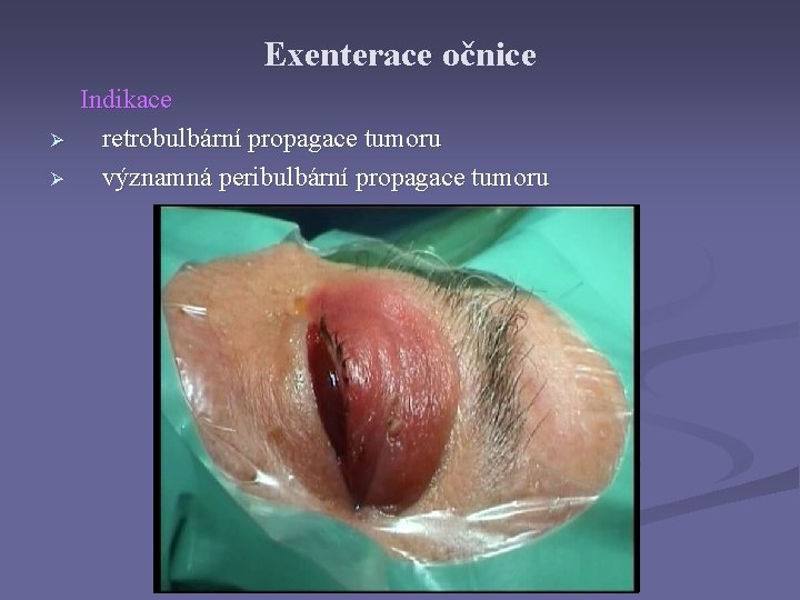 Exenterace očnice Ø Ø Indikace retrobulbární propagace tumoru významná peribulbární propagace tumoru 