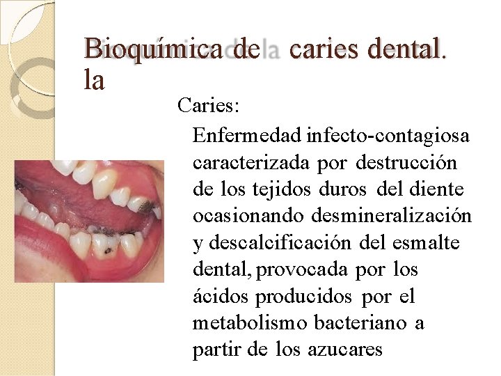 Bioquímica de caries dental. la Caries: Enfermedad infecto-contagiosa caracterizada por destrucción de los tejidos