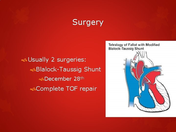 Surgery Usually 2 surgeries: Blalock-Taussig Shunt December 28 th Complete TOF repair 