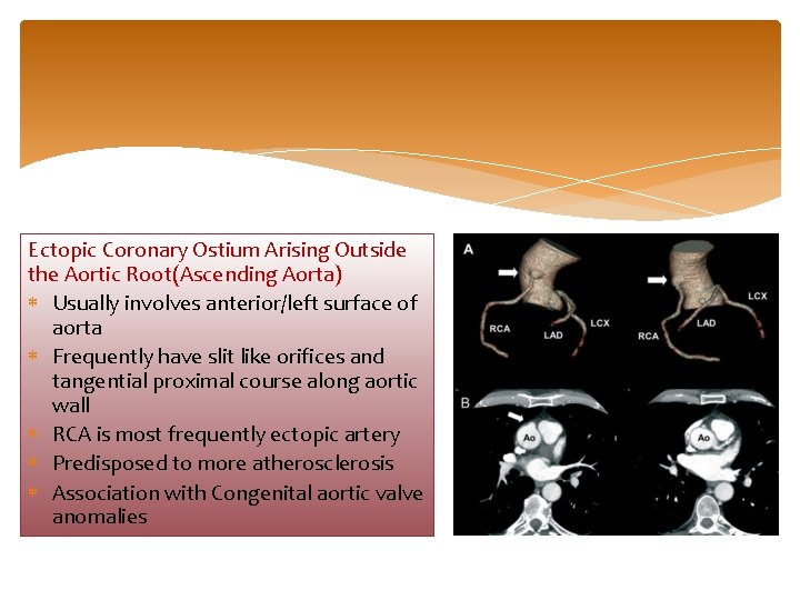 Ectopic Coronary Ostium Arising Outside the Aortic Root(Ascending Aorta) Usually involves anterior/left surface of