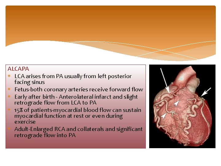 ALCAPA LCA arises from PA usually from left posterior facing sinus Fetus-both coronary arteries