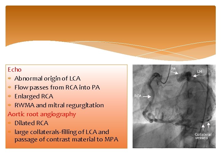 Echo Abnormal origin of LCA Flow passes from RCA into PA Enlarged RCA RWMA