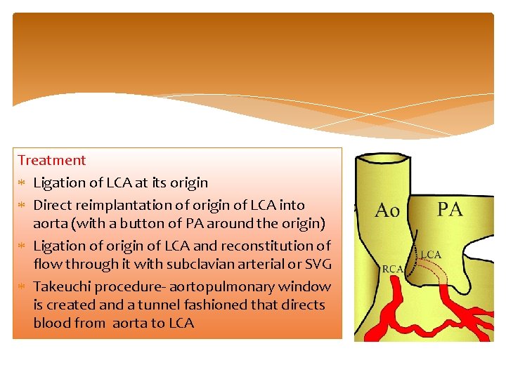 Treatment Ligation of LCA at its origin Direct reimplantation of origin of LCA into