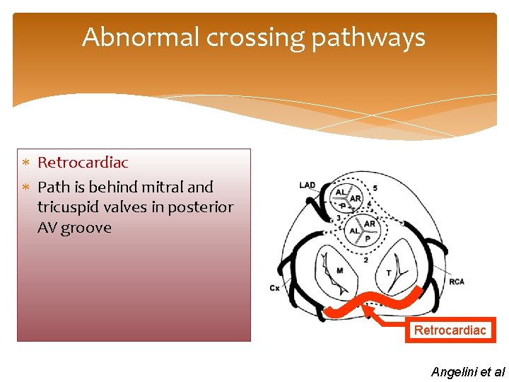Abnormal crossing pathways Retrocardiac Path is behind mitral and tricuspid valves in posterior AV