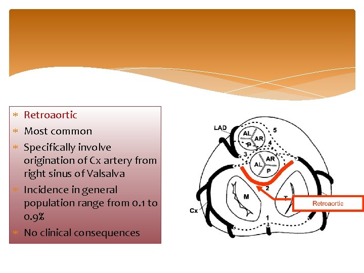  Retroaortic Most common Specifically involve origination of Cx artery from right sinus of