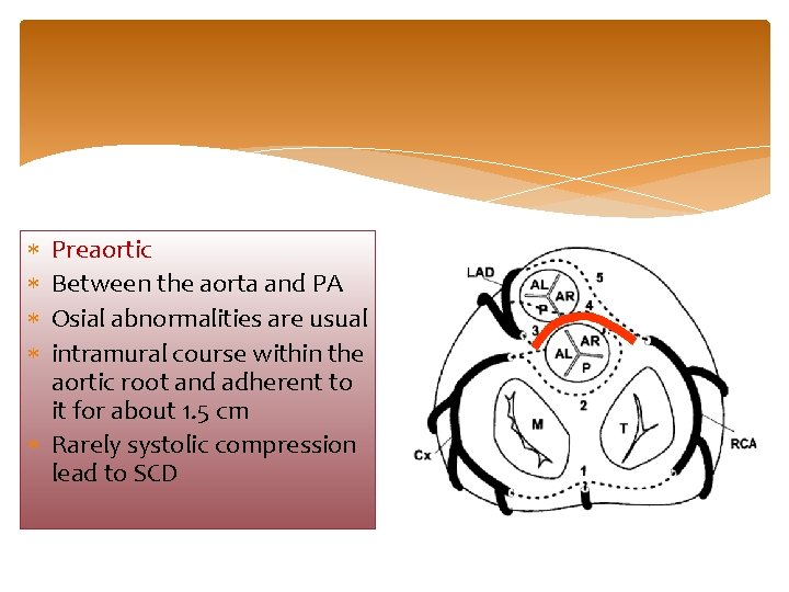  Preaortic Between the aorta and PA Osial abnormalities are usual intramural course within