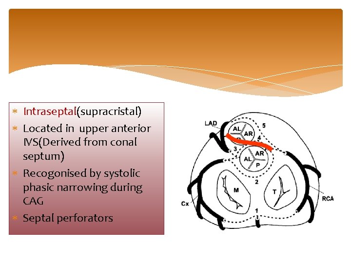  Intraseptal(supracristal) Located in upper anterior IVS(Derived from conal septum) Recogonised by systolic phasic