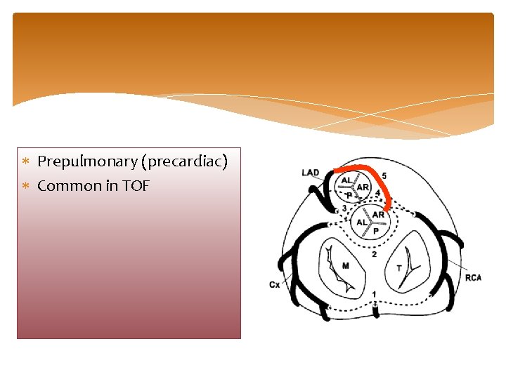  Prepulmonary (precardiac) Common in TOF 