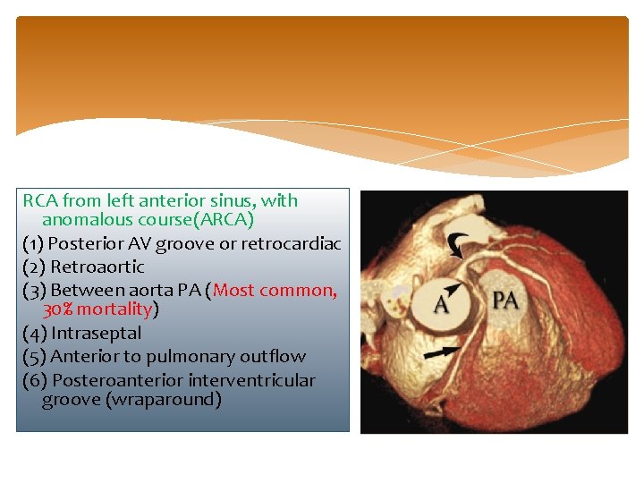 RCA from left anterior sinus, with anomalous course(ARCA) (1) Posterior AV groove or retrocardiac