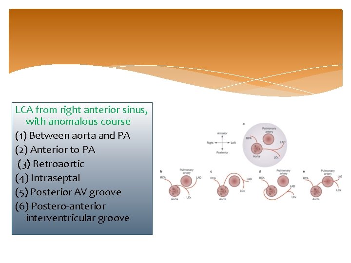 LCA from right anterior sinus, with anomalous course (1) Between aorta and PA (2)