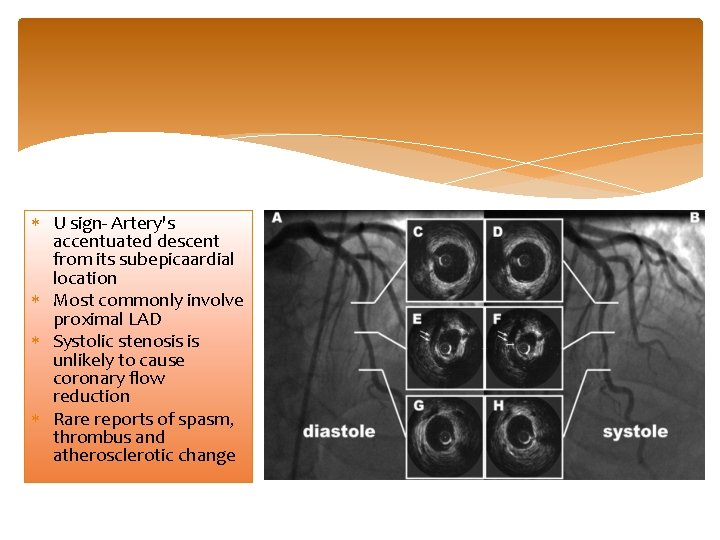  U sign- Artery's accentuated descent from its subepicaardial location Most commonly involve proximal