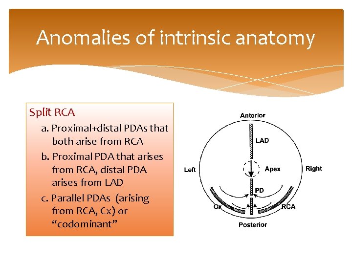 Anomalies of intrinsic anatomy Split RCA a. Proximal+distal PDAs that both arise from RCA