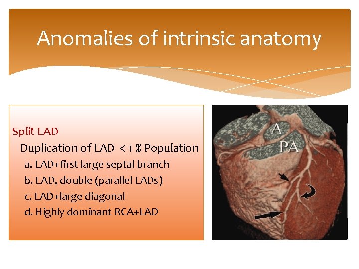 Anomalies of intrinsic anatomy Split LAD Duplication of LAD < 1 % Population a.