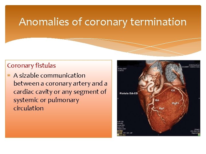 Anomalies of coronary termination Coronary fistulas A sizable communication between a coronary artery and