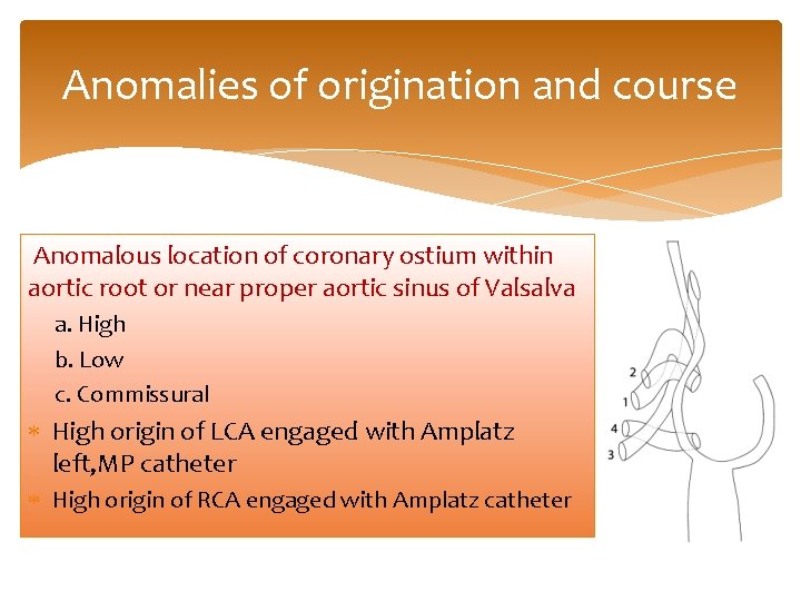 Anomalies of origination and course Anomalous location of coronary ostium within aortic root or