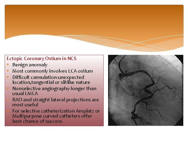 Ectopic Coronary Ostium in NCS Benign anomaly Most commonly involves LCA ostium Difficult cannulation-unexpected