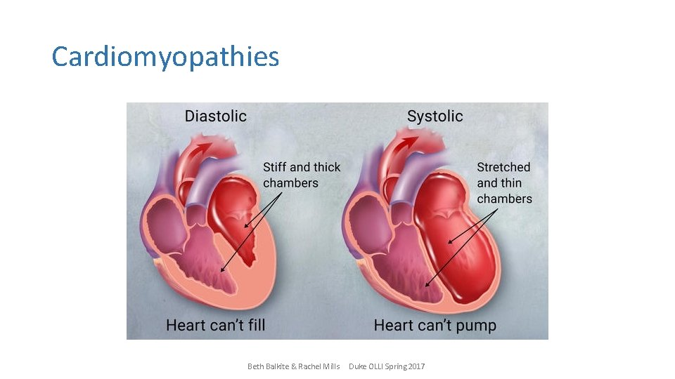 Cardiomyopathies Beth Balkite & Rachel Mills Duke OLLI Spring 2017 