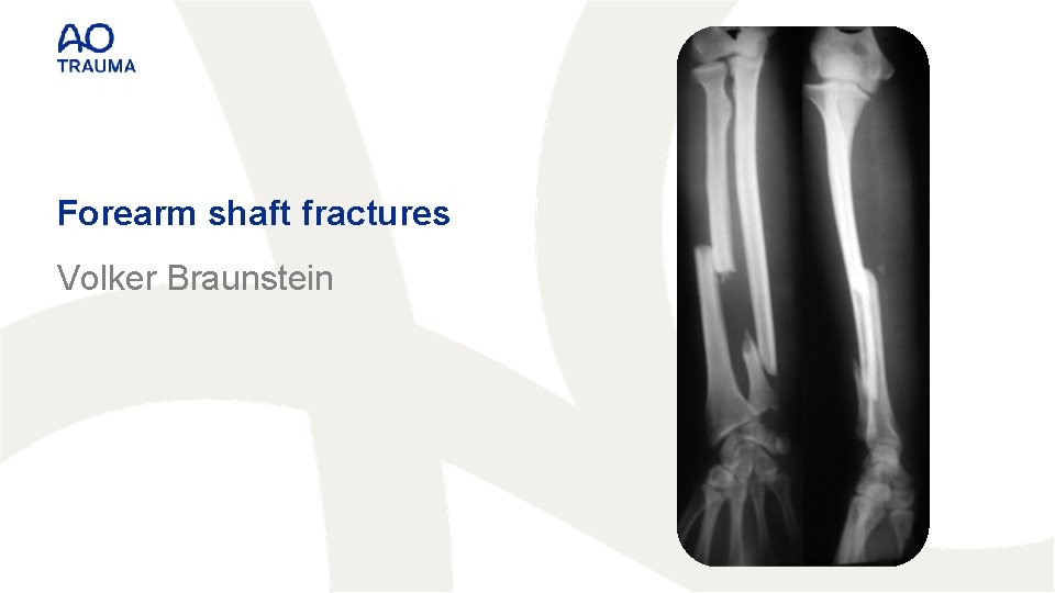 Forearm shaft fractures Volker Braunstein 