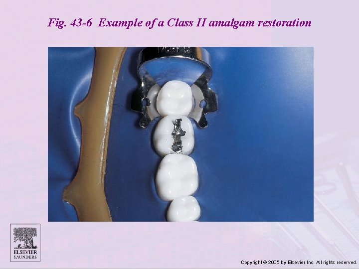 Fig. 43 -6 Example of a Class II amalgam restoration Copyright © 2005 by