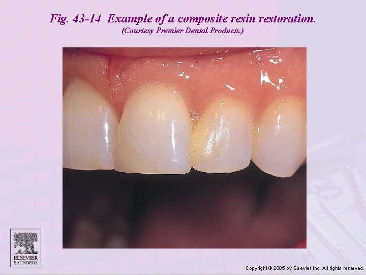 Fig. 43 -14 Example of a composite resin restoration. (Courtesy Premier Dental Products. )