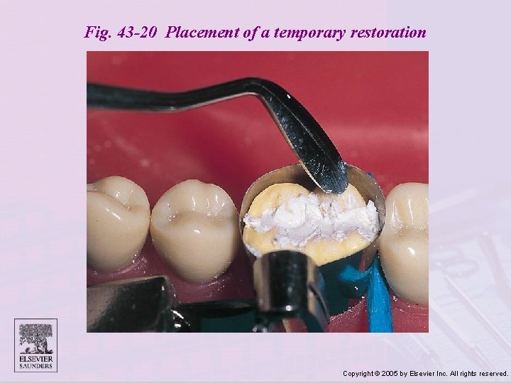 Fig. 43 -20 Placement of a temporary restoration Copyright © 2005 by Elsevier Inc.