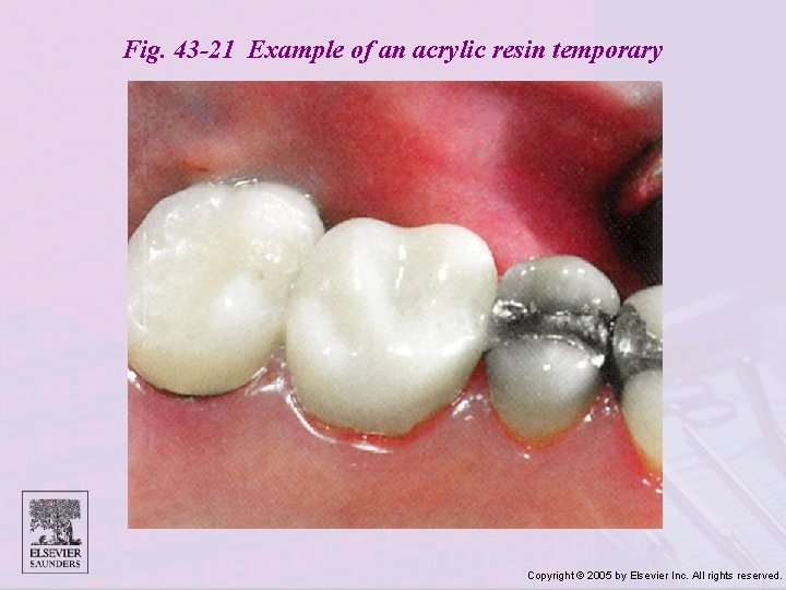 Fig. 43 -21 Example of an acrylic resin temporary Copyright © 2005 by Elsevier