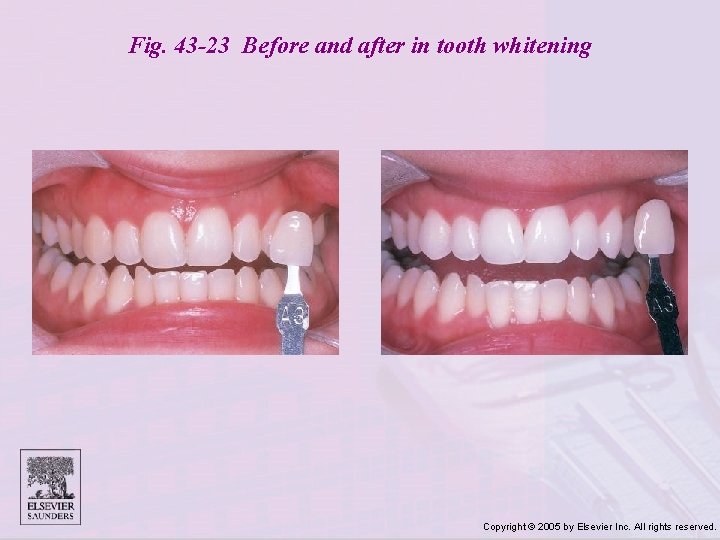 Fig. 43 -23 Before and after in tooth whitening Copyright © 2005 by Elsevier