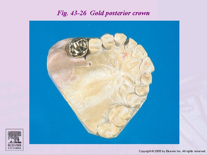 Fig. 43 -26 Gold posterior crown Copyright © 2005 by Elsevier Inc. All rights