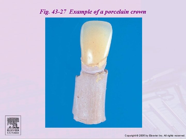 Fig. 43 -27 Example of a porcelain crown Copyright © 2005 by Elsevier Inc.