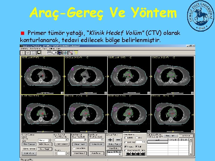 Araç-Gereç Ve Yöntem Primer tümör yatağı, “Klinik Hedef Volüm” (CTV) olarak konturlanarak, tedavi edilecek