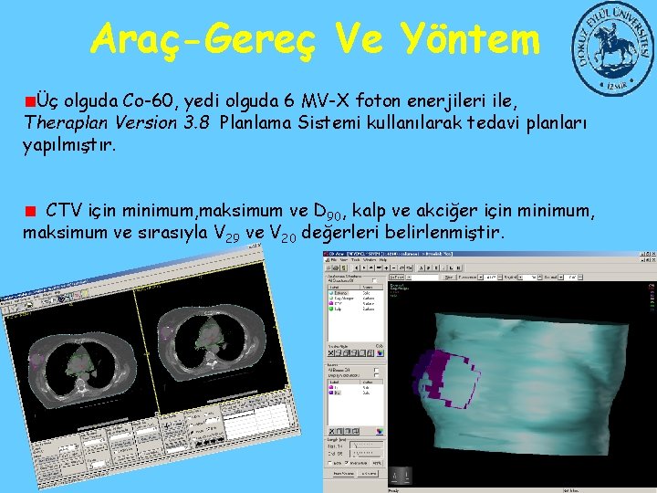 Araç-Gereç Ve Yöntem Üç olguda Co-60, yedi olguda 6 MV-X foton enerjileri ile, Theraplan