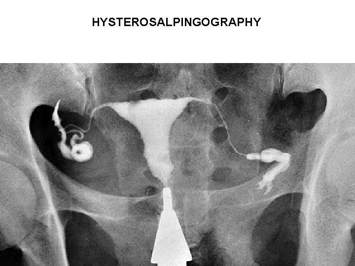 HYSTEROSALPINGOGRAPHY 