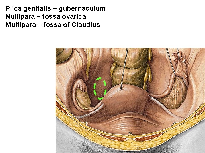 Plica genitalis – gubernaculum Nullipara – fossa ovarica Multipara – fossa of Claudius 