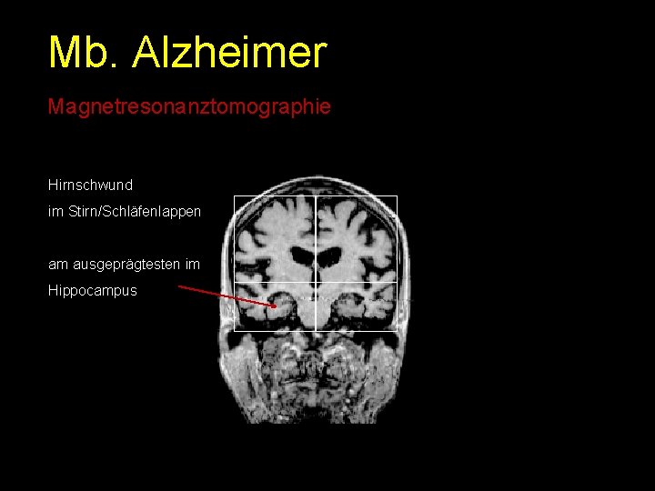 Mb. Alzheimer Magnetresonanztomographie Hirnschwund im Stirn/Schläfenlappen am ausgeprägtesten im Hippocampus 