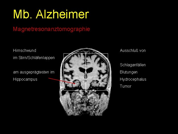 Mb. Alzheimer Magnetresonanztomographie Hirnschwund Ausschluß von im Stirn/Schläfenlappen Schlaganfällen am ausgeprägtesten im Blutungen Hippocampus