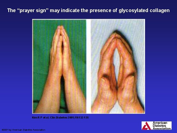 The “prayer sign” may indicate the presence of glycosylated collagen Kim R P et