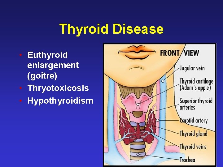 Thyroid Disease • Euthyroid enlargement (goitre) • Thryotoxicosis • Hypothyroidism 