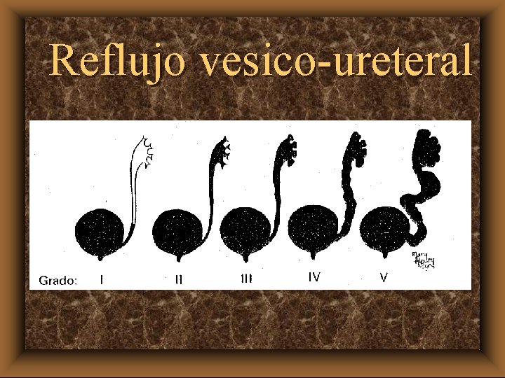 Reflujo vesico-ureteral 