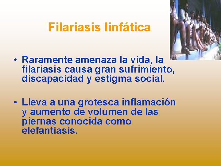 Filariasis linfática • Raramente amenaza la vida, la filariasis causa gran sufrimiento, discapacidad y