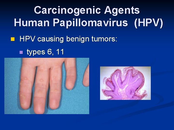 Carcinogenic Agents Human Papillomavirus (HPV) n HPV causing benign tumors: n types 6, 11