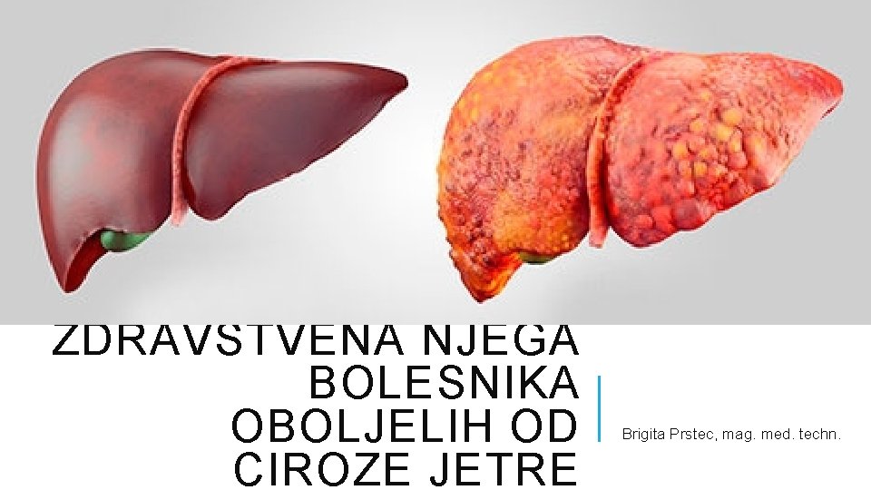 ZDRAVSTVENA NJEGA BOLESNIKA OBOLJELIH OD CIROZE JETRE Brigita Prstec, mag. med. techn. 