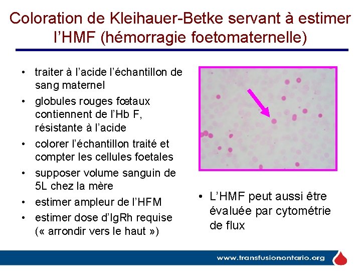 Coloration de Kleihauer-Betke servant à estimer l’HMF (hémorragie foetomaternelle) • traiter à l’acide l’échantillon Coloration de Kleihauer-Betke servant à estimer l’HMF (hémorragie foetomaternelle) • traiter à l’acide l’échantillon
