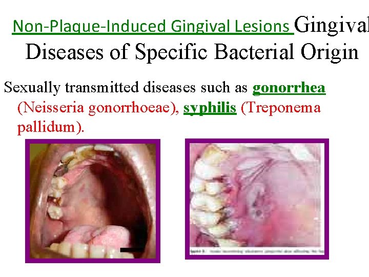 Non-Plaque-Induced Gingival Lesions Gingival Diseases of Specific Bacterial Origin Sexually transmitted diseases such as Non-Plaque-Induced Gingival Lesions Gingival Diseases of Specific Bacterial Origin Sexually transmitted diseases such as