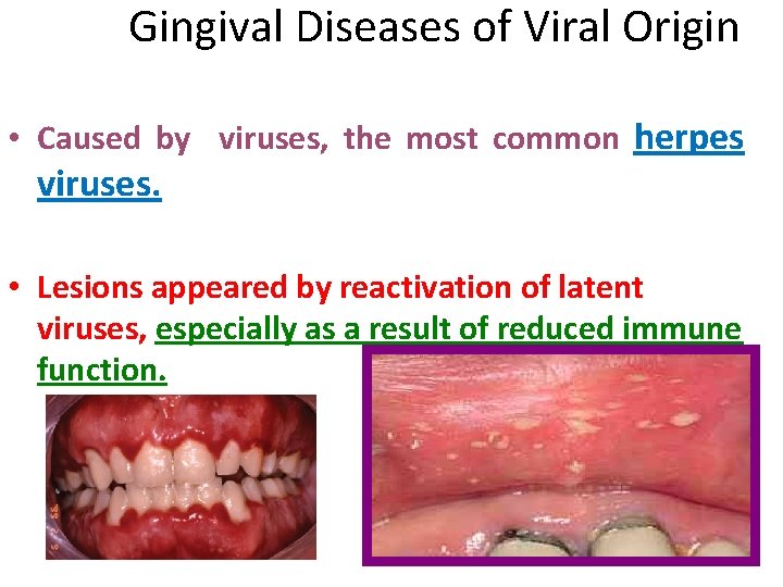 Gingival Diseases of Viral Origin • Caused by viruses, the most common herpes viruses. Gingival Diseases of Viral Origin • Caused by viruses, the most common herpes viruses.