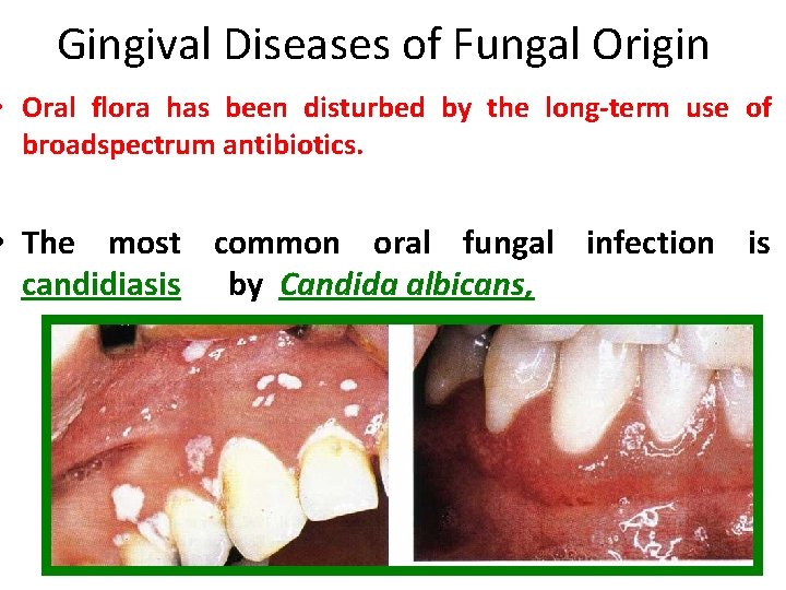 Gingival Diseases of Fungal Origin • Oral flora has been disturbed by the long-term Gingival Diseases of Fungal Origin • Oral flora has been disturbed by the long-term