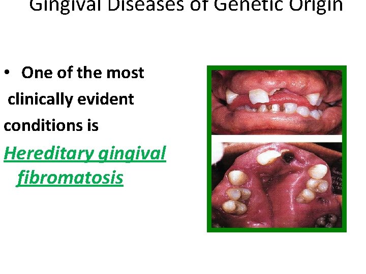 Gingival Diseases of Genetic Origin • One of the most clinically evident conditions is Gingival Diseases of Genetic Origin • One of the most clinically evident conditions is