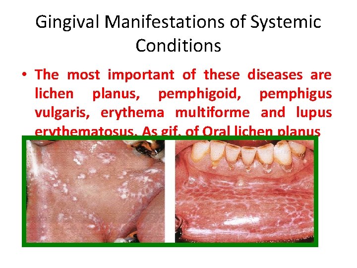 Gingival Manifestations of Systemic Conditions • The most important of these diseases are lichen Gingival Manifestations of Systemic Conditions • The most important of these diseases are lichen