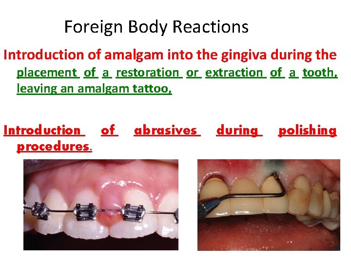 Foreign Body Reactions Introduction of amalgam into the gingiva during the placement of a Foreign Body Reactions Introduction of amalgam into the gingiva during the placement of a