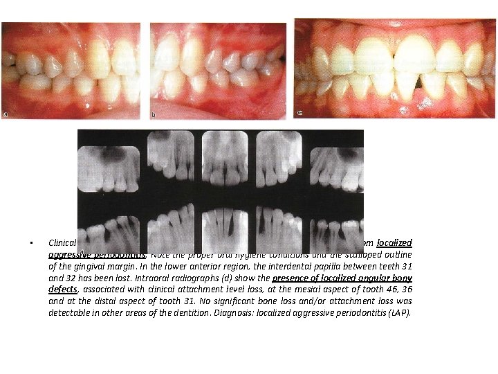 • Clinical appearance of the periodontal tissues of a 15 -year-old girl suffering • Clinical appearance of the periodontal tissues of a 15 -year-old girl suffering